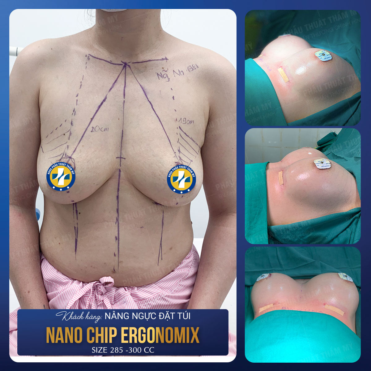 Khoa phẫu thuật tạo hình thẩm mỹ – Bv. Chấn thương chỉnh hình Nghệ An lựa chọn số 1 để nâng ngực đẹp và an toàn