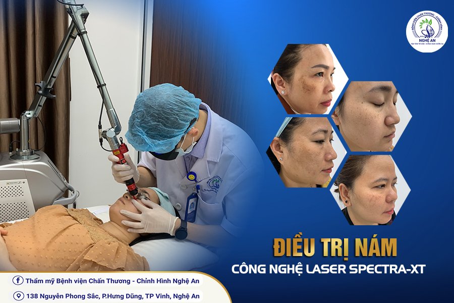 Tháo gỡ “gánh nặng” tâm lý cho phụ nữ bị nám bằng công nghệ Laser hiện đạ