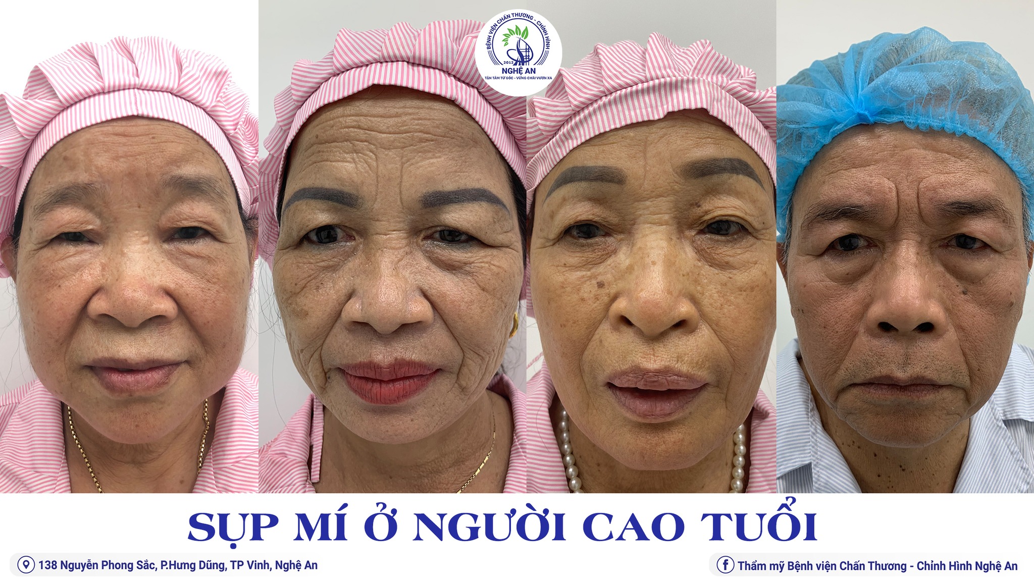 Địa chỉ điều trị sụp mí an toàn, hiệu quả cho người cao tuổi ở Nghệ An