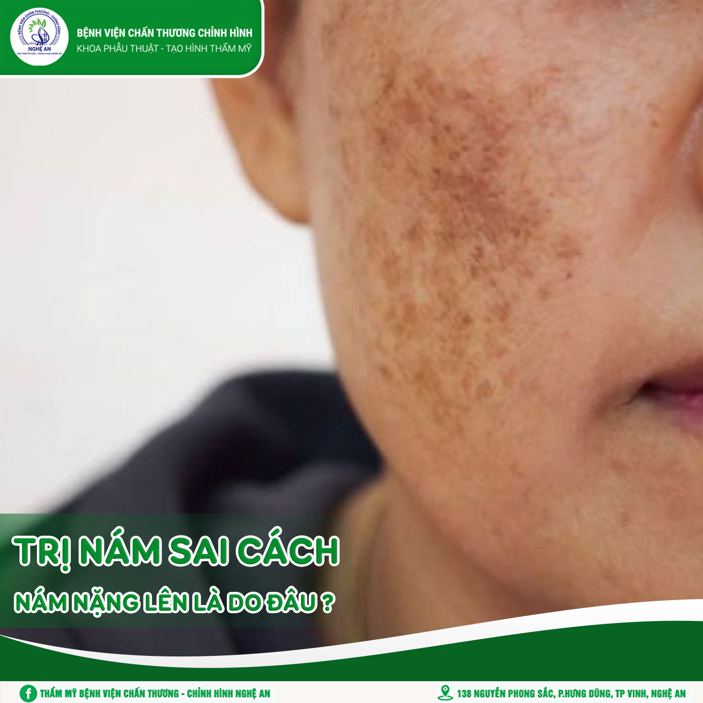 TRỊ NÁM SAI CÁCH, NÁM NẶNG LÊN LÀ DO ĐÂU?
