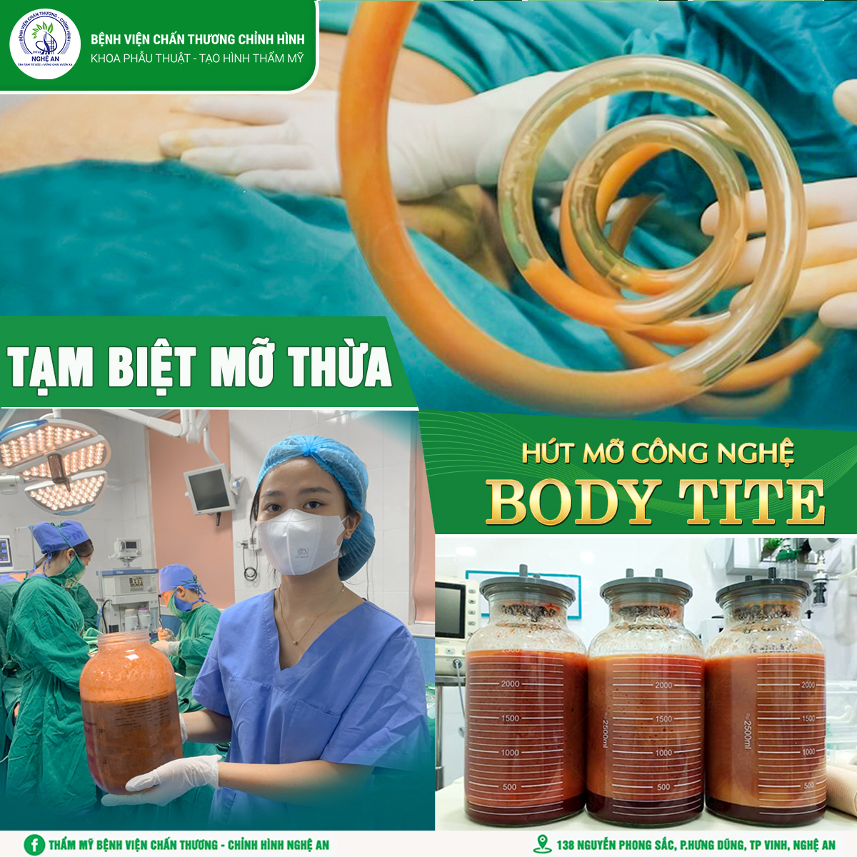 HÚT MỠ AN TOÀN BẰNG CÔNG NGHỆ BODY TITE TẠI KHOA PHẪU THUẬT TẠO HÌNH THẨM MỸ