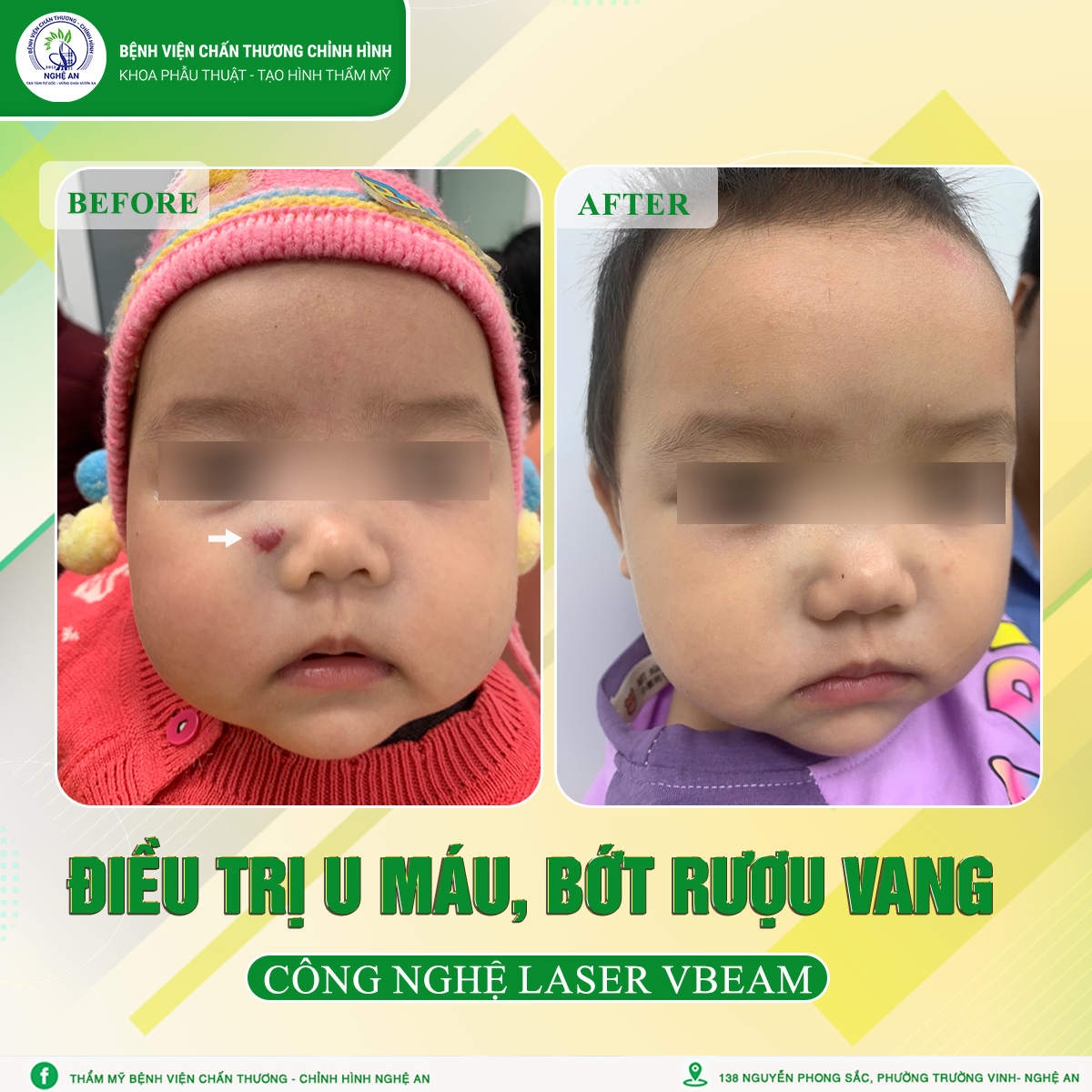 ĐIỀU TRỊ U MÁU, BỚT RƯỢU VANG CHO CON CÀNG SỚM – HIỆU QUẢ CÀNG CAO!